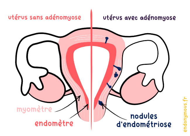 schéma uterus adenomyose maladie gynécologique lésion endomètre myomètre