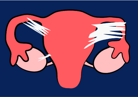 schéma uterus endométriose endometriose maladie gynécologique adherences