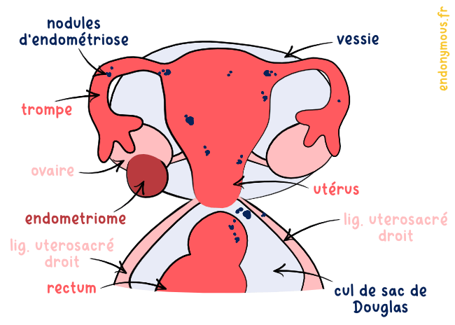schéma uterus endometriose maladie gynécologique lésion abdomen femme
