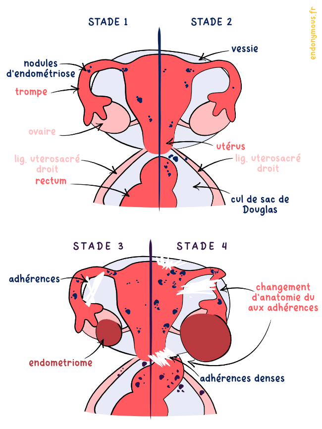 schema endometriose stades adherence uterus, colon vessie lesions endometriome